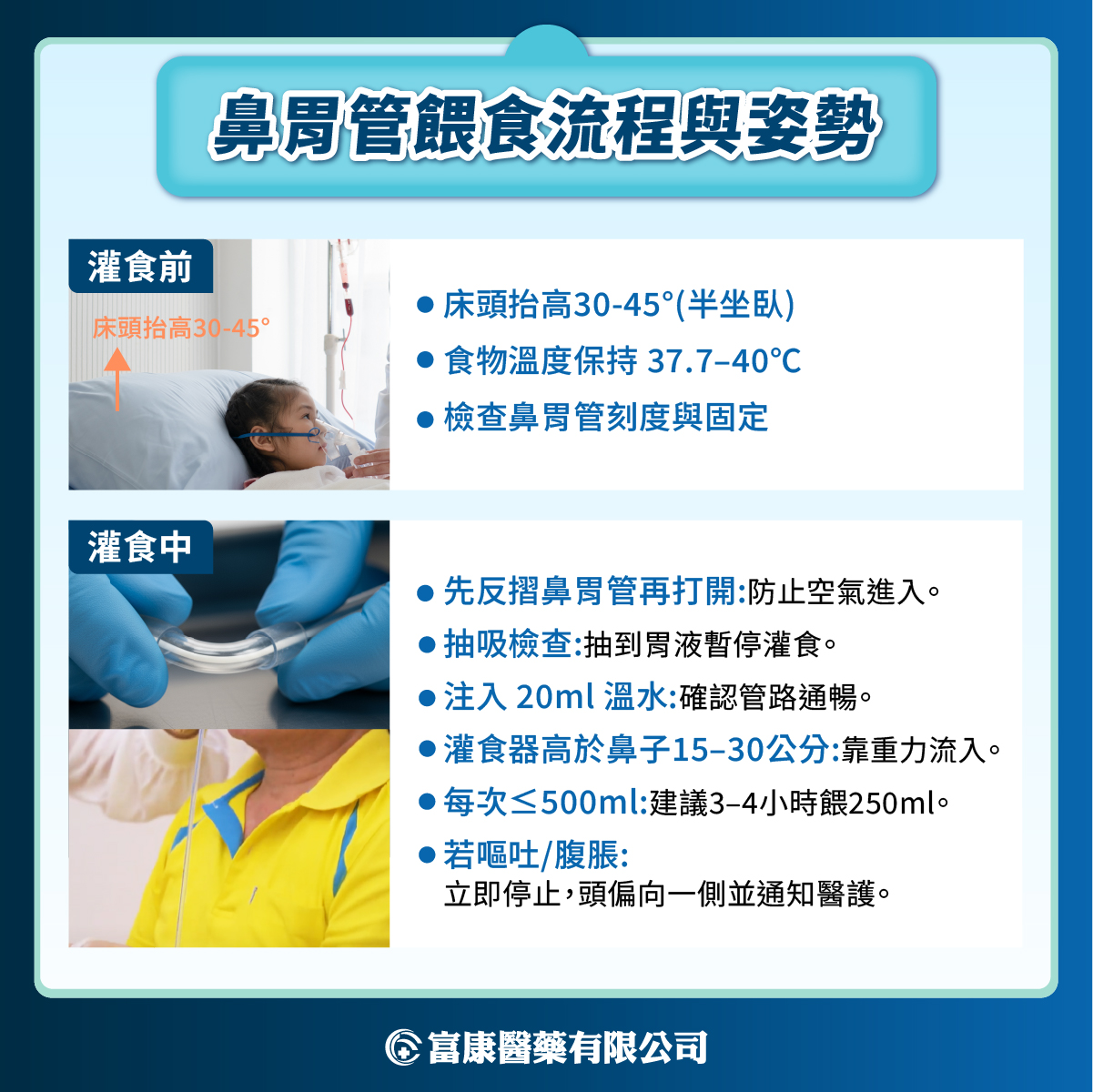 照顧鼻胃管病人,怎麼做最安全?兩截式鼻胃管的實用優勢與教學 鼻胃管餵食流程與姿勢